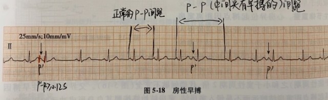 很多人查完心電圖看不懂只能找醫生看今天簡單說一下