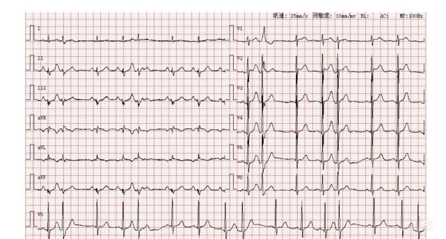 房性早搏伴心室內差異性傳導分析:如圖可知,患者為竇性心律各導聯第2.