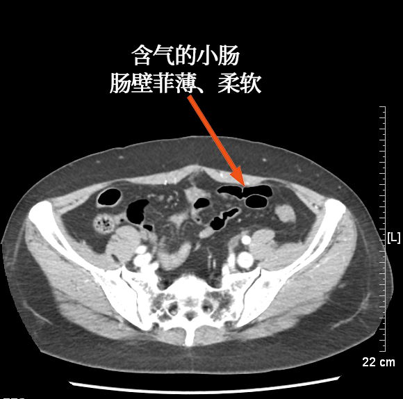 是发现异常征像的基础解剖基础ct 是诊断肠道与肠系膜损伤,穿孔的主要