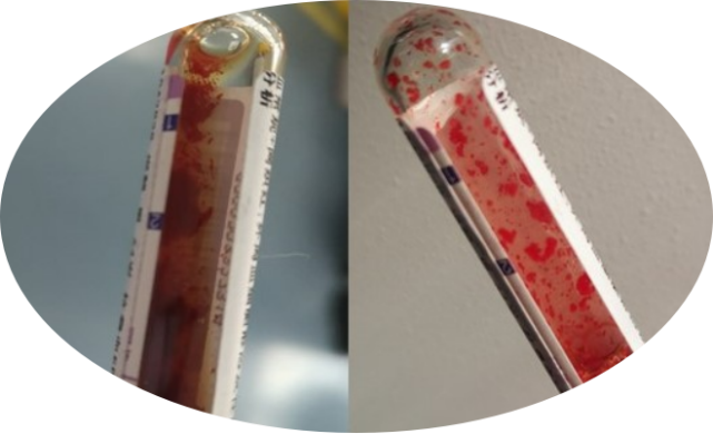 一例红细胞冷凝集导致血常规计数偏差