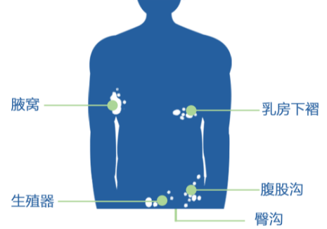 膚康科普尋常型銀屑病發病初期的這些表現你都知道嗎