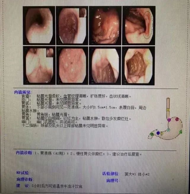 5cm大小的潰瘍性病變,胃竇多處糜爛;醫生分別小心地取了活檢.