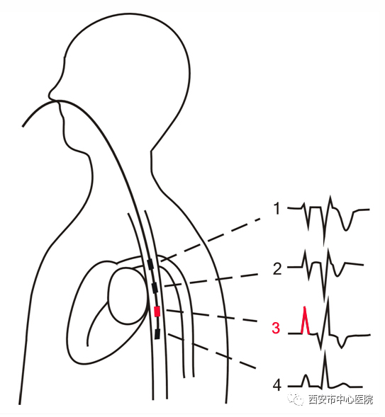 您了解食道心电图食道调搏吗