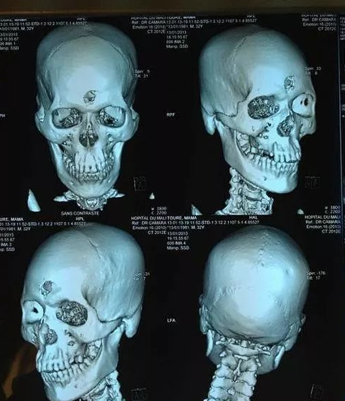 现代人头部ct片,显示前额坏了给392号头颅做ct(合成图)还不放心,随后
