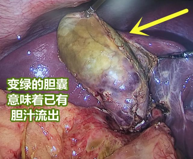 結合病情,張主任為她安排了微創手術——腹腔鏡膽囊切除 腸粘連鬆解術