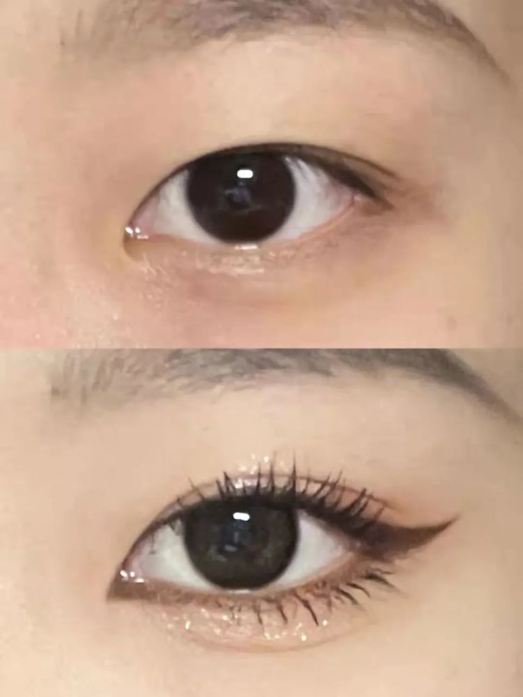 徒手开内眼角教程|宽眼距内眦赘皮有救了!