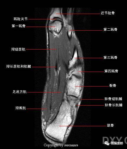 7 中間楔骨,8 拇收肌(橫頭),9 外側楔骨,10 蚓狀肌,11 跗骨背側韌帶