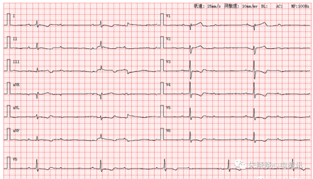 患者女,73岁,因胸闷心悸来医院就诊,图为其体检心电图第1585期读图