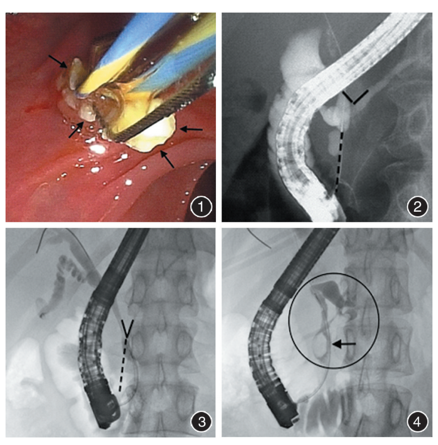 202111论著经内镜逆行胰胆管造影术在胰胆管合流异常诊治中的价值分析