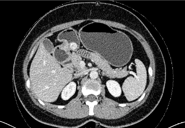 图2:动脉期图1:平扫全身pet/ct示:胃窦小弯侧内凸结节,代谢稍增高