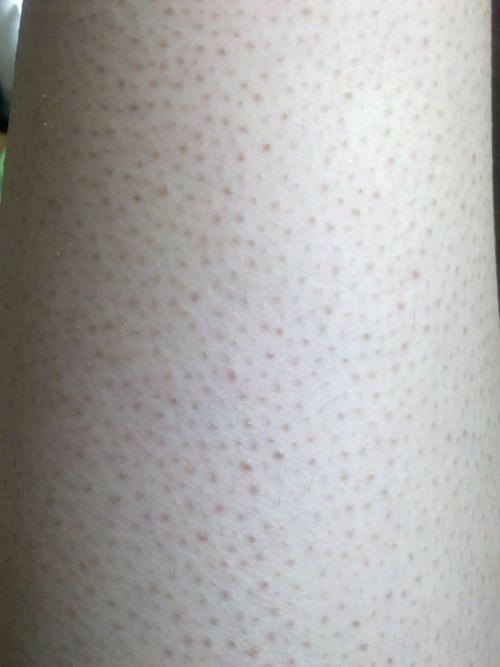 毛孔像鸡皮疙瘩一样怎么办(毛孔像鸡皮疙瘩一样怎么办啊)