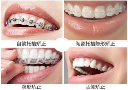牙齿矫正方法有哪些?该如何选择适合自己的矫正方式呢