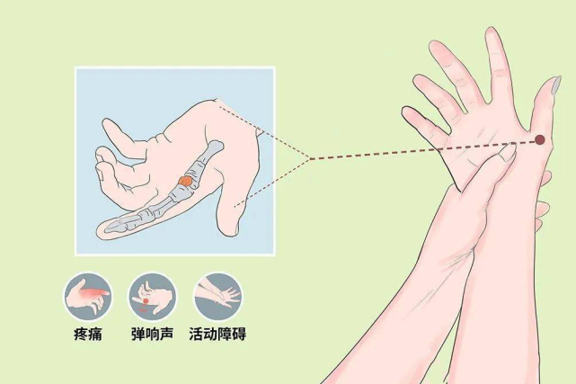 衝擊波治療拇指屈指肌腱狹窄性腱鞘炎臨床觀察