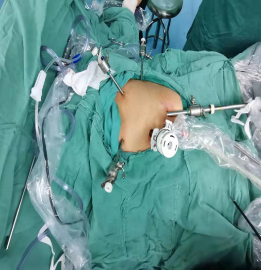 微创切除7cm血管瘤术后12小时患者就下地