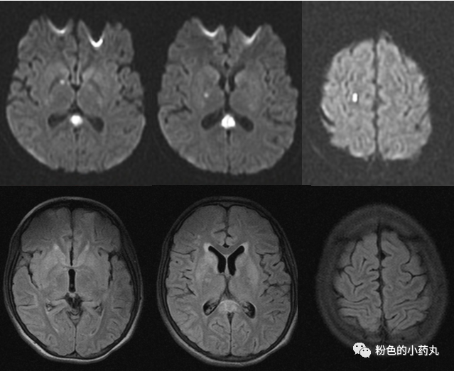 leigh综合征,你了解吗?_腾讯新闻