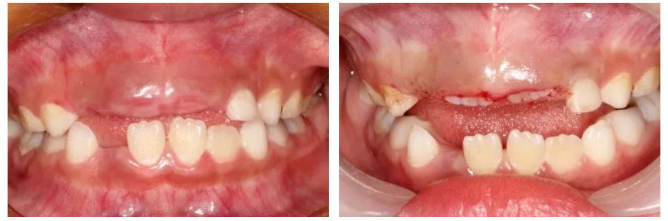 孩子牙齦鼓包除了是馬牙還可能是這5種疾病