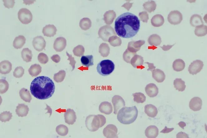 形态组人员复片:分类计数100个白细胞可见60个有核红细胞,且有病态