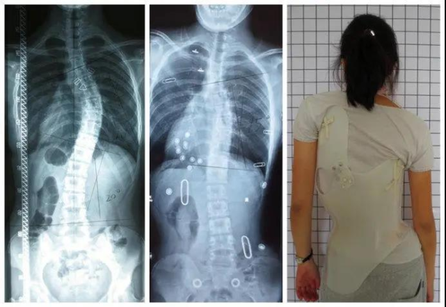 高低肩弯腰驼背可能是脊柱侧弯松江这个专病门诊开诊啦