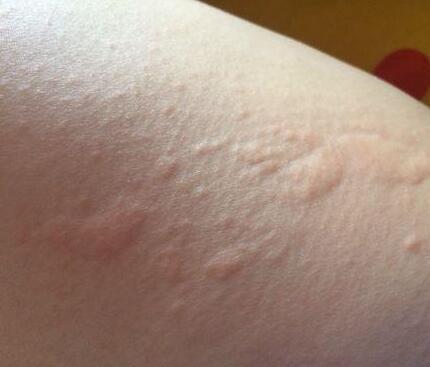 外科心法要诀》记载:"此证俗称鬼风疙瘩,有汗出受风,或卧露乘凉,风