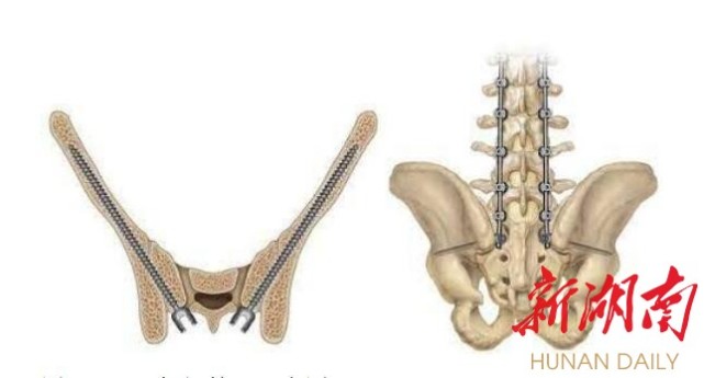 sacral canal图片