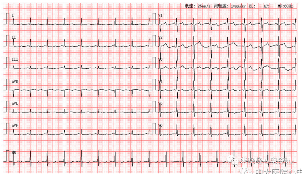 每日读图第1588期房性心动过速stt波异常