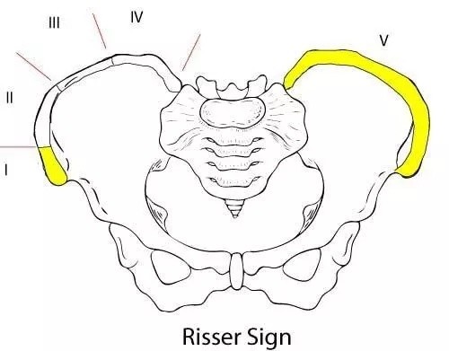 什么是risser征—倍他运动康复_腾讯新闻