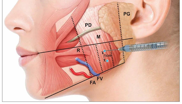 咬肌注射点位置图图片