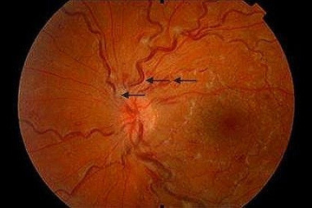 视网膜中央静脉阻塞的病因是什么