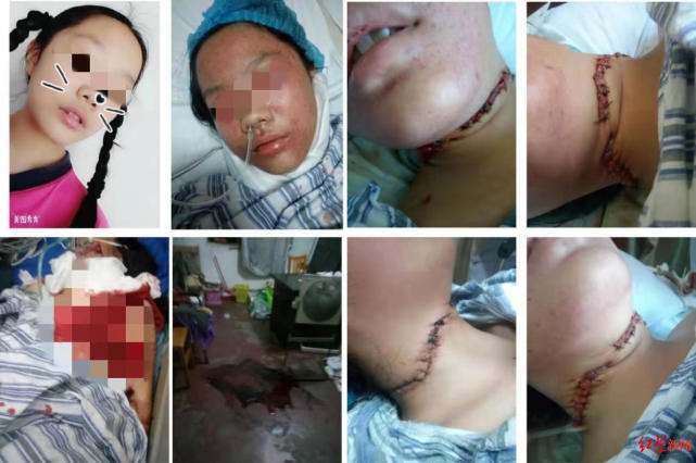 13岁女孩被17岁邻居用菜刀割颈,公检鉴定为轻伤 家属:希望重审定罪