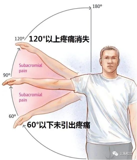 肩袖损伤症状图片