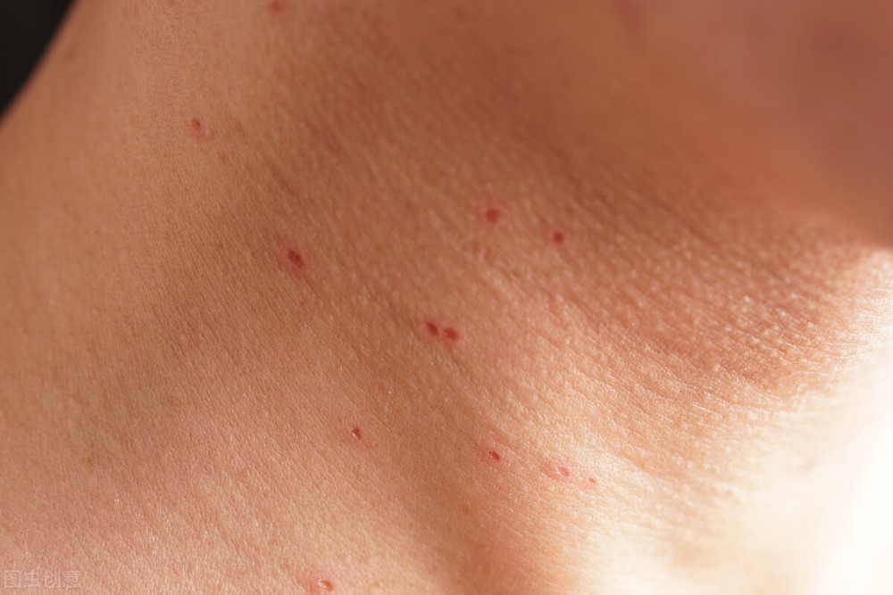 2,扁平疣,表现为大小不等的小丘疹,轻度隆起,形状多样,有圆形,椭圆形