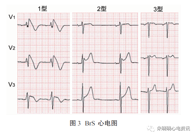 brugada综合征传统认识与证据的更新