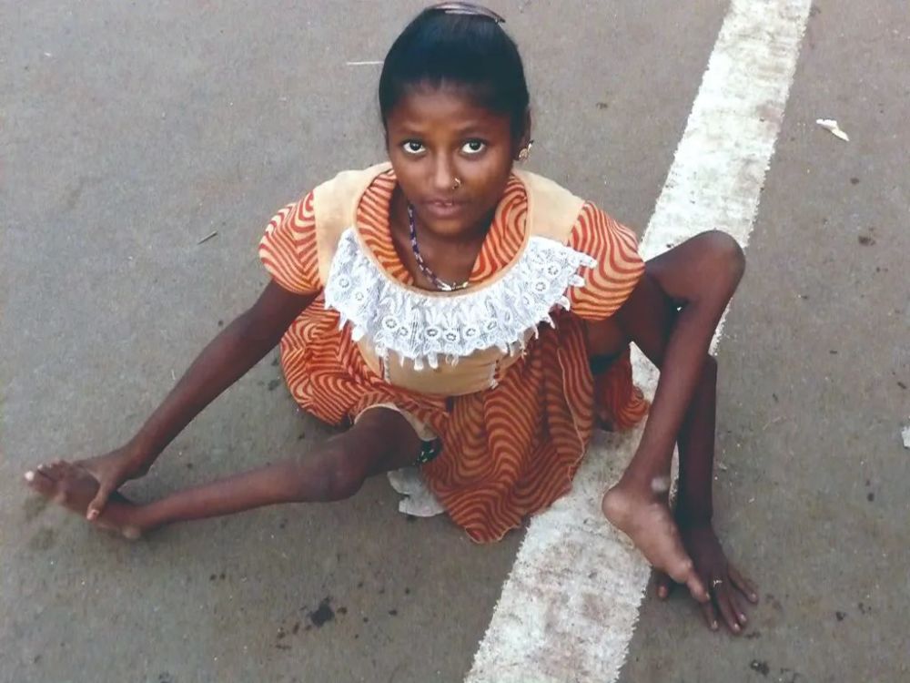 (上下图)许多小儿麻痹症患者会落下四肢萎缩的终身残疾.