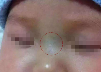 如果小儿高热,眉间,鼻柱和唇周围色青,多属于小儿惊风(惊厥)或者是