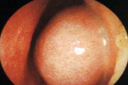 如何防治鼻黏膜受损|鼻腔|鼻粘膜|鼻黏膜|黏膜