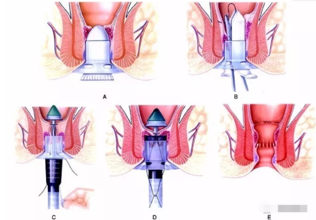 世界上最痛苦的临床手术是什么?痔疮,肛瘘都上榜