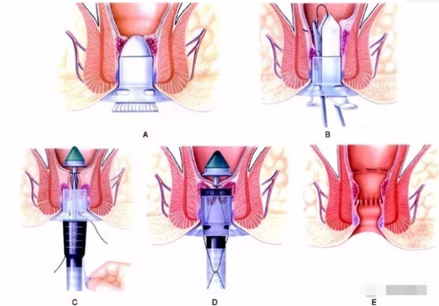 世界上最痛苦的臨床手術是什麼痔瘡肛瘻都上榜