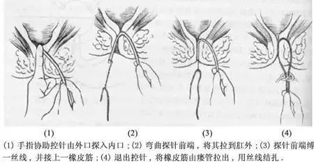 世界上最痛苦的臨床手術是什麼痔瘡肛瘻都上榜