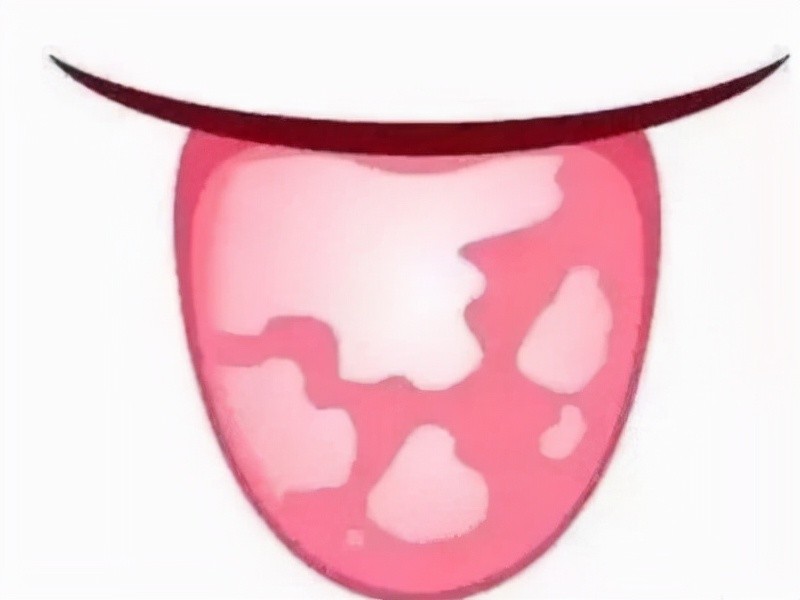 像地图一样的"花舌头",要不要治疗?