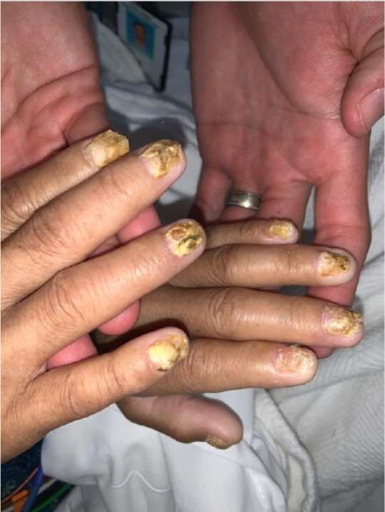 腹泻电解质紊乱肾功能异常如何诊断病例学习