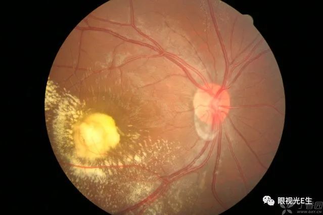 性視網膜血管炎黃斑孔弓形體大血管瘤rppm fuchs斑phpvpcv晚霞狀眼底