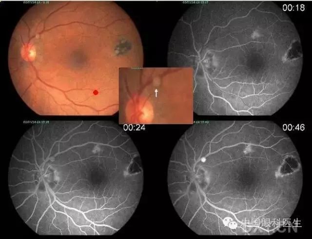 常见眼科病例的眼底照片集锦|视网膜血管瘤|眼科|视网膜病变