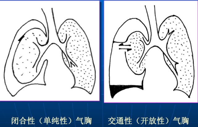 三种气胸的比较图图片