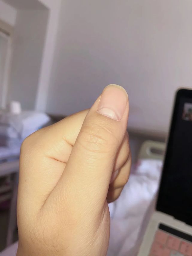 我拍了照片,发在班群里跟大家讨论,最后我们得出结论大概率是"米氏线"