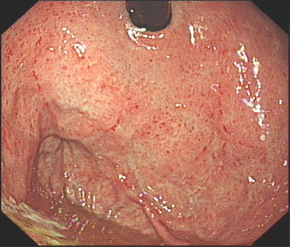 病例分享磁控胶囊胃镜借rac识hpylori一例