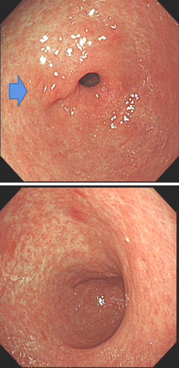 左右滑动查看▼mce与胃镜:胃窦,幽门mce:胃角mce:胃角mce:胃角胃镜:胃