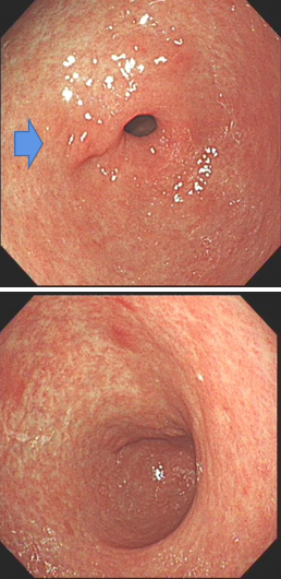 贲门胃底癌胃镜图片图片