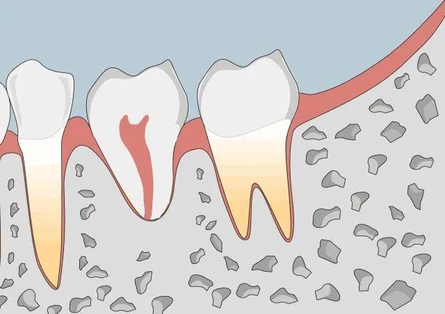 還不知道什麼是牙根吸收?掉牙預警!