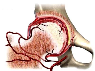 髋关节疼痛活动受限哪些原因引起股骨头坏死