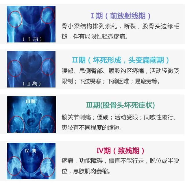 髋关节疼痛活动受限哪些原因引起股骨头坏死